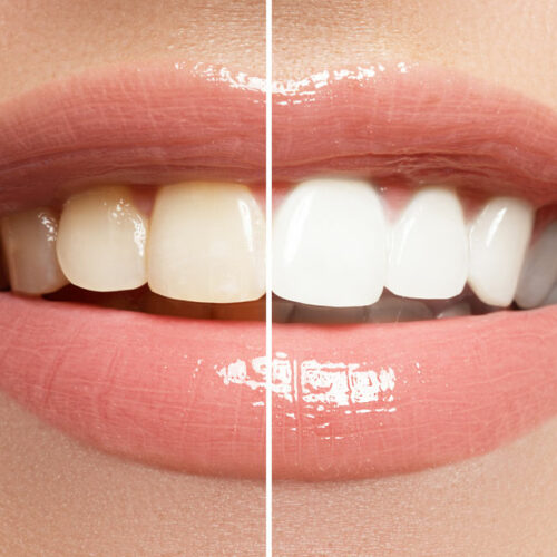 5 tips to achieve a pearly white smile