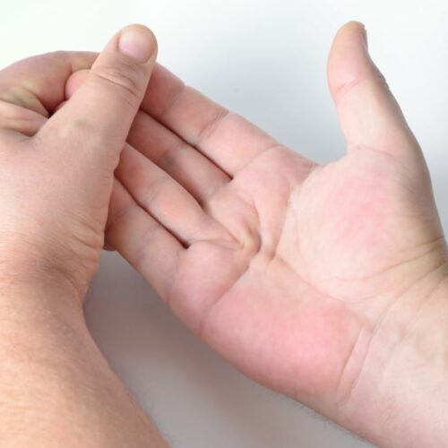 4 warning signs of Dupuytren&#8217;s contracture